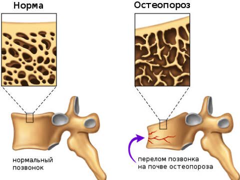 перелом при остеопорозе